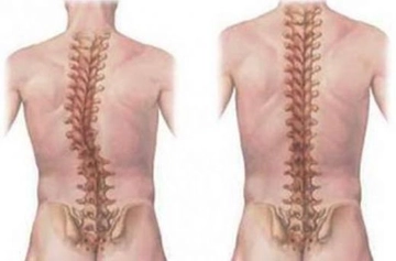 Kuyruk Sokumu Hastalıkları Belirtileri ve Tedavisi